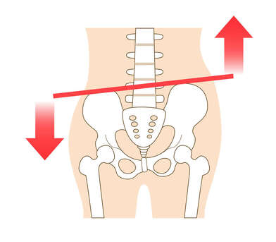 Hip hitch, Lateral pelvic tilt
